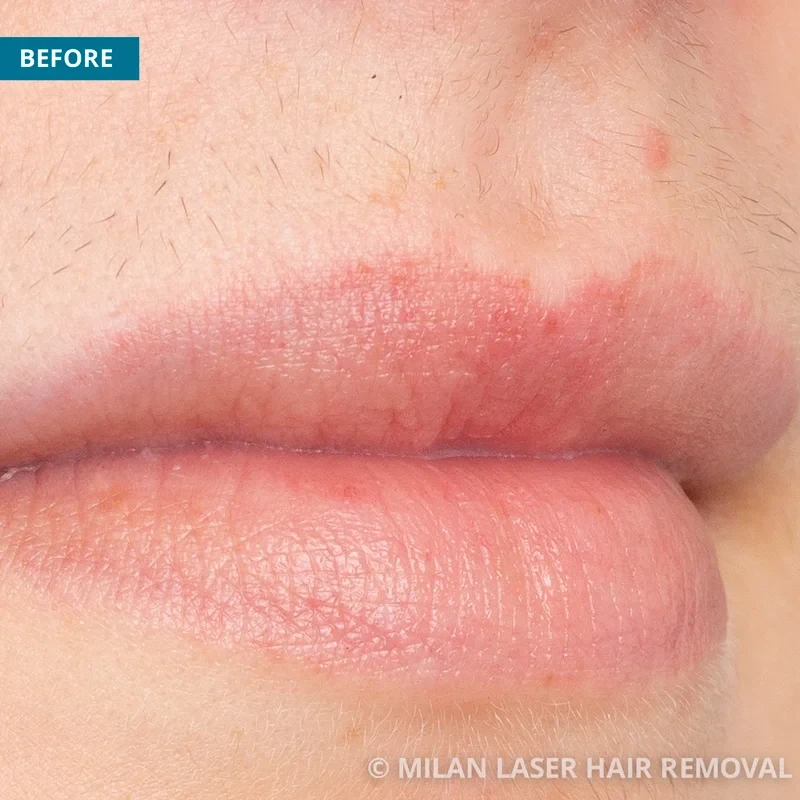 Face Before After Photos of Laser Hair Removal Milan Laser in